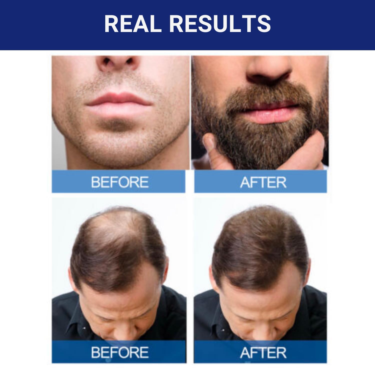 Minoxidil-5% Extra Strength Hair Regrowth for Men, 6 Month Supply