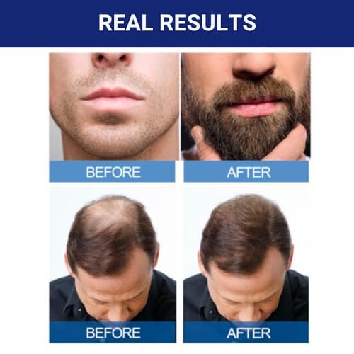 Minoxidil-5% Extra Strength Hair Regrowth for Men, 6 Month Supply