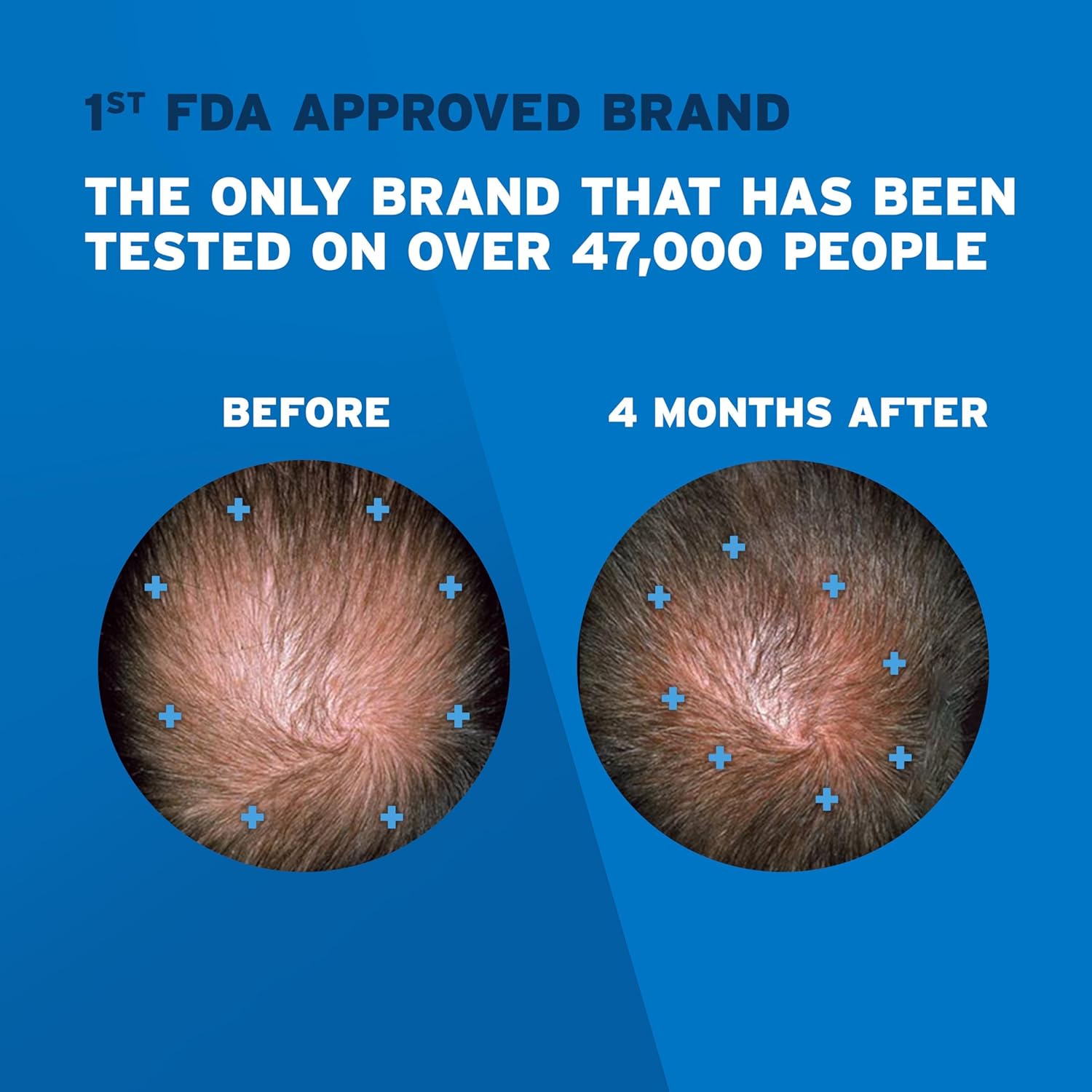 Men's Rogaine Extra Strength 5% Minoxidil Topical Solution for Thin Hair, Hair Loss Treatment to Regrow Fuller, Thicker Hair, 3-Month Supply, 3 x 2 fl. oz